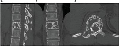 Case report: DKRd regimen in the treatment of newly diagnosed POEMS syndrome and literature review